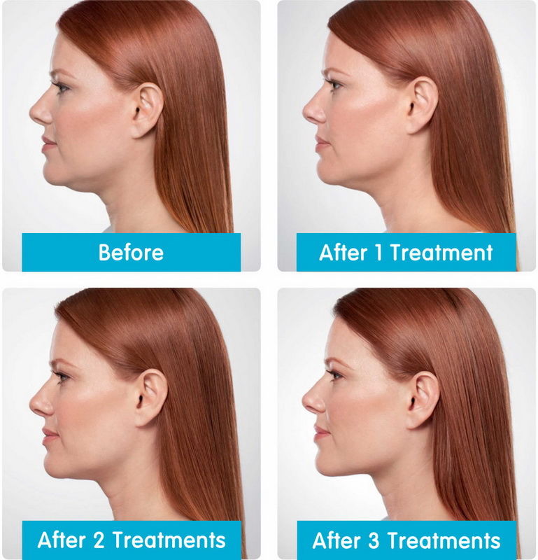 Non-Invasive Double Chin Reduction